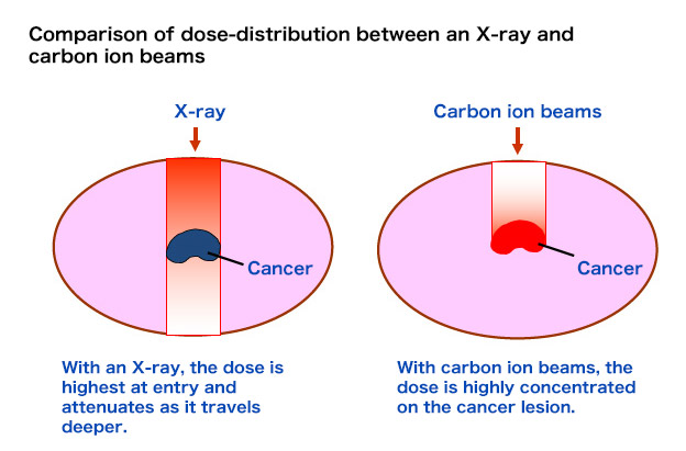 Figure 1. Comparison of dose-distribution between an X-ray and carbon ion beams