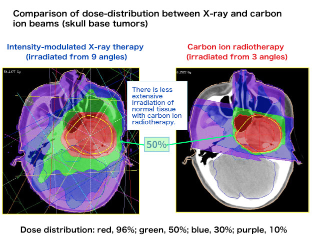 Figure 2. Comparison of dose-distribution between X-ray and carbon ion beams (skull base tumors)