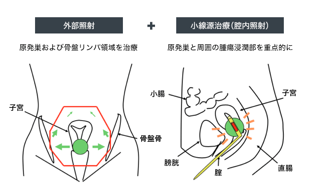 子宮がんの放射線治療