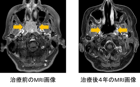 治療前後のMRI画像