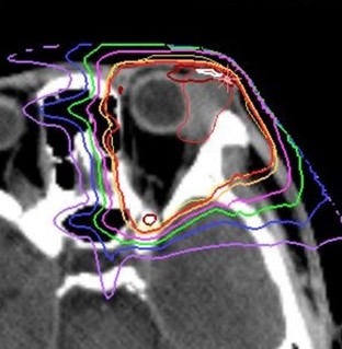 図2 涙腺がんに対する線量分布図