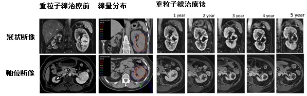 線量分布と治療経過