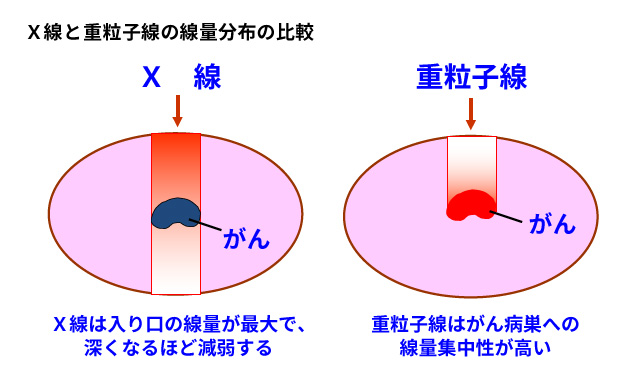 図1. X線と重粒子線の線量分布の比較