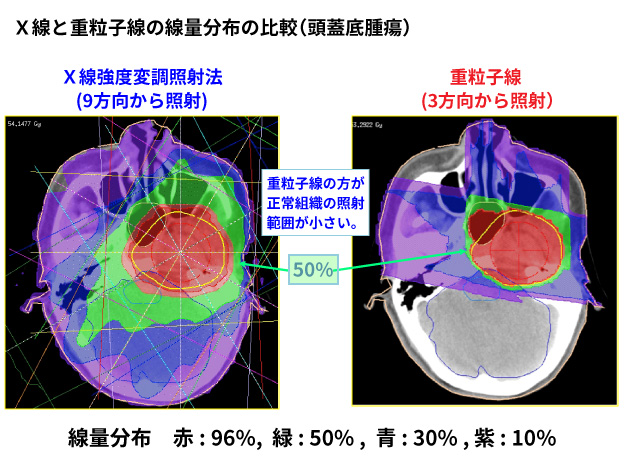 図2. X線と重粒子線の線量分布の比較（頭蓋底腫瘍）