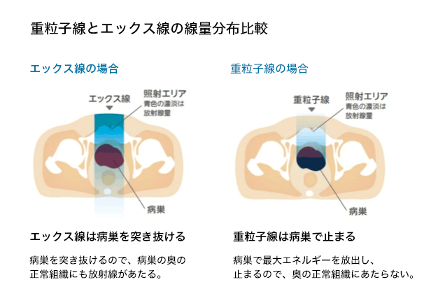 重粒子線とエックス線の線量分布比較