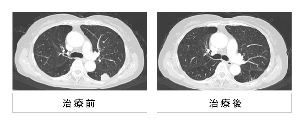 図1 IA期腺がん、重粒子線1回照射治療前後のCT