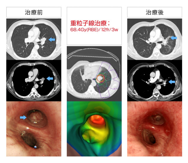 図2 cT2aN1M0IIA期扁平上皮がん、重粒子線照射治療前後のCT、内視鏡