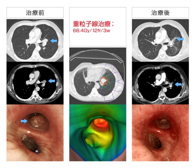 図2 cT2aN1M0IIA期扁平上皮がん、重粒子線照射治療前後のCT、内視鏡