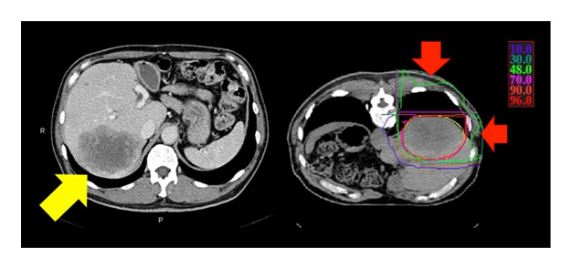 図1 典型的な肝腫瘍に対する重粒子線治療の放射線線量分布（例は大腸がん肝転移）
