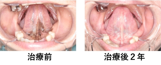 治療前後の舌下面写真
