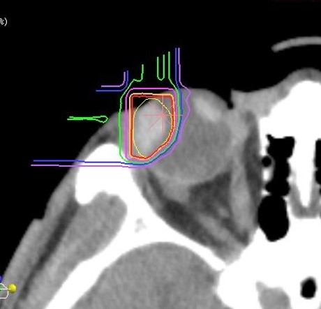 図1 脈絡膜悪性黒色腫に対する線量分布図