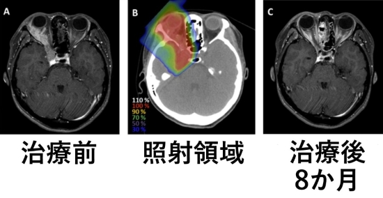 治療前後と照射領域の画像